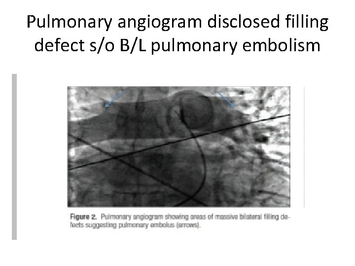 Pulmonary angiogram disclosed filling defect s/o B/L pulmonary embolism 