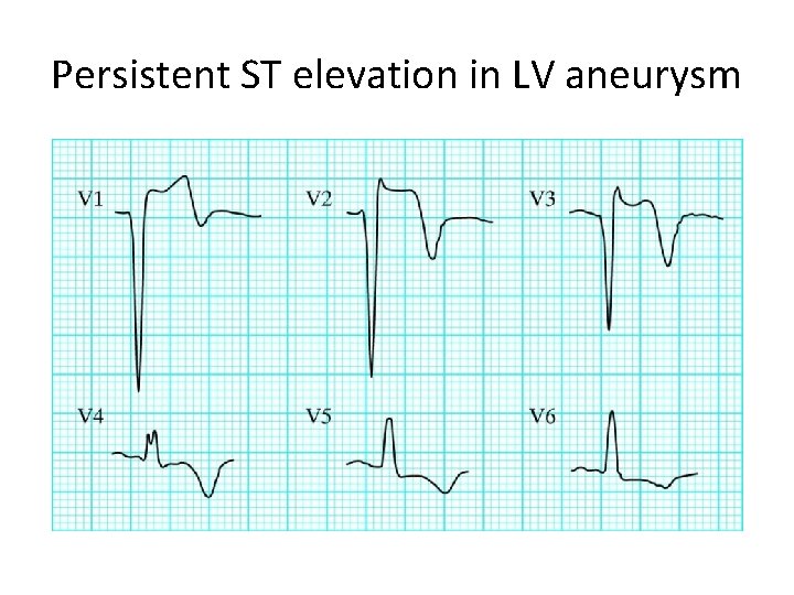 Persistent ST elevation in LV aneurysm 