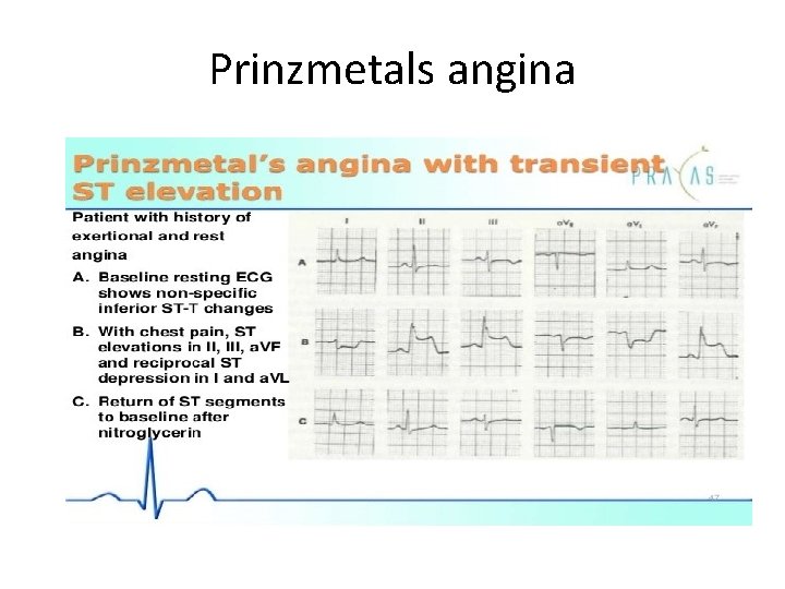 Prinzmetals angina 