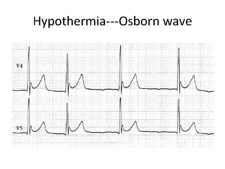 Hypothermia---Osborn wave 