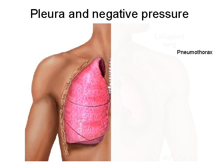 Pleura and negative pressure Pneumothorax 