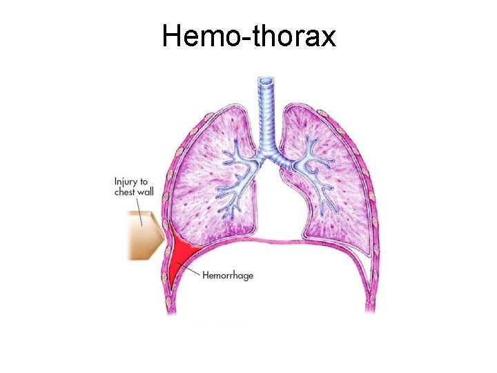 Hemo-thorax 