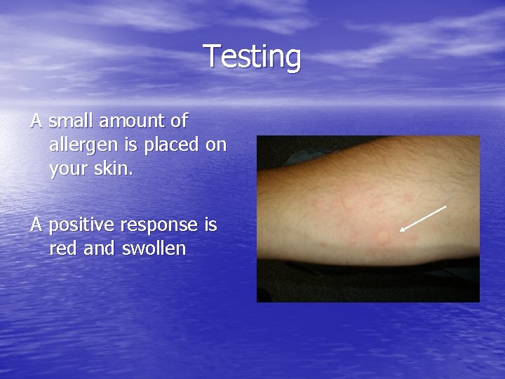 Testing A small amount of allergen is placed on your skin. A positive response