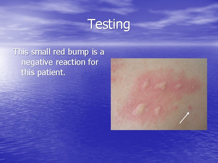 Testing This small red bump is a negative reaction for this patient. 