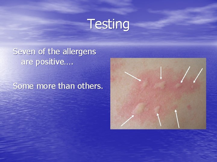 Testing Seven of the allergens are positive…. Some more than others. 