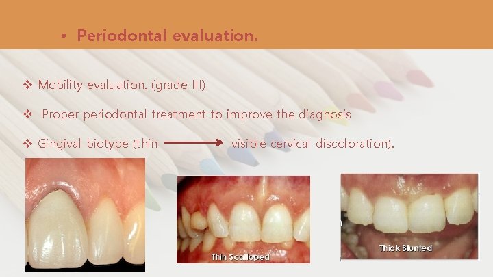  • Periodontal evaluation. v Mobility evaluation. (grade III) v Proper periodontal treatment to