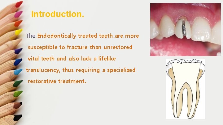 Introduction. The Endodontically treated teeth are more susceptible to fracture than unrestored vital teeth
