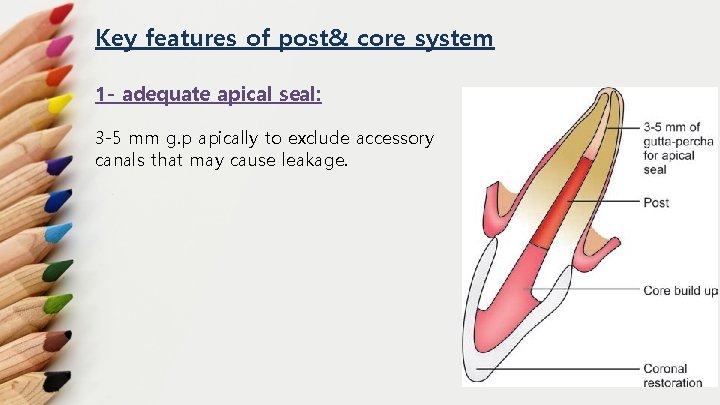 Key features of post& core system 1 - adequate apical seal: 3 -5 mm