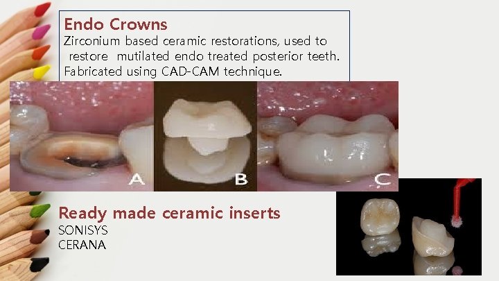 Endo Crowns Zirconium based ceramic restorations, used to restore mutilated endo treated posterior teeth.
