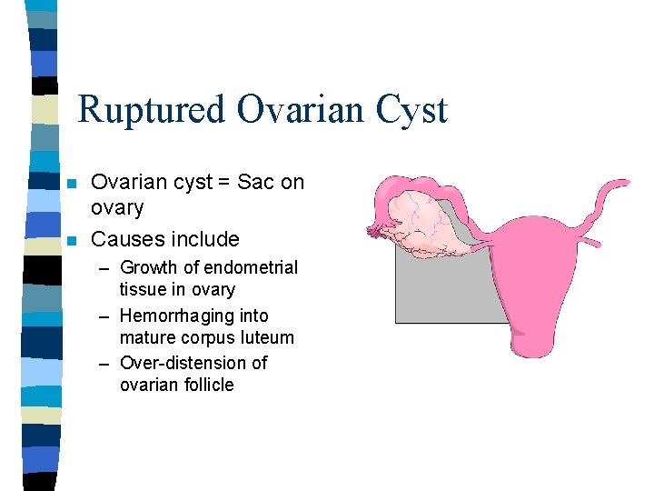 Ruptured Ovarian Cyst n n Ovarian cyst = Sac on ovary Causes include – Ruptured Ovarian Cyst n n Ovarian cyst = Sac on ovary Causes include –