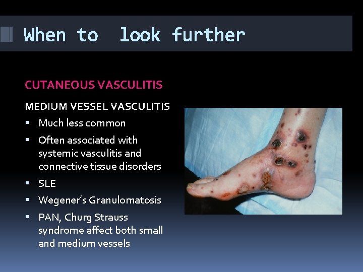 When to look further CUTANEOUS VASCULITIS MEDIUM VESSEL VASCULITIS Much less common Often associated