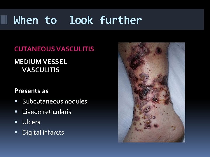 When to look further CUTANEOUS VASCULITIS MEDIUM VESSEL VASCULITIS Presents as Subcutaneous nodules Livedo