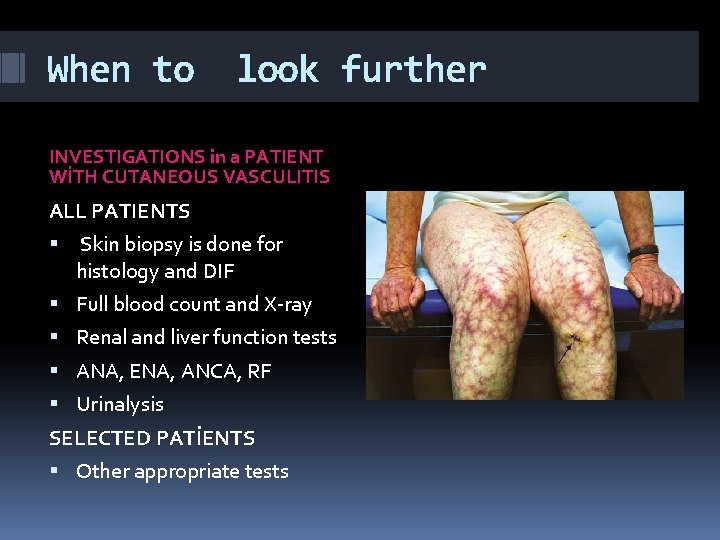 When to look further INVESTIGATIONS in a PATIENT WİTH CUTANEOUS VASCULITIS ALL PATIENTS Skin