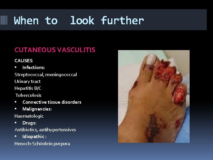 When to look further CUTANEOUS VASCULITIS CAUSES Infections: Streptococcal, meningococcal Urinary tract Hepatitis B/C