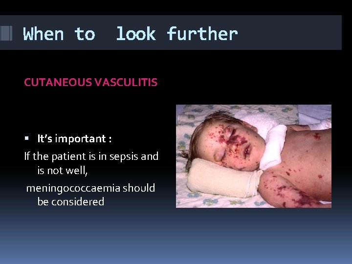 When to look further CUTANEOUS VASCULITIS It’s important : If the patient is in