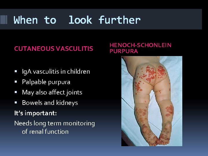 When to look further CUTANEOUS VASCULITIS Ig. A vasculitis in children Palpable purpura May