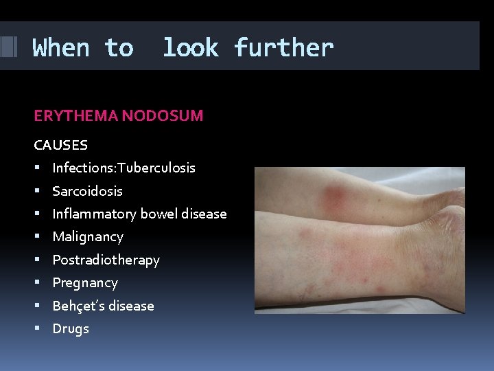 When to look further ERYTHEMA NODOSUM CAUSES Infections: Tuberculosis Sarcoidosis Inflammatory bowel disease Malignancy