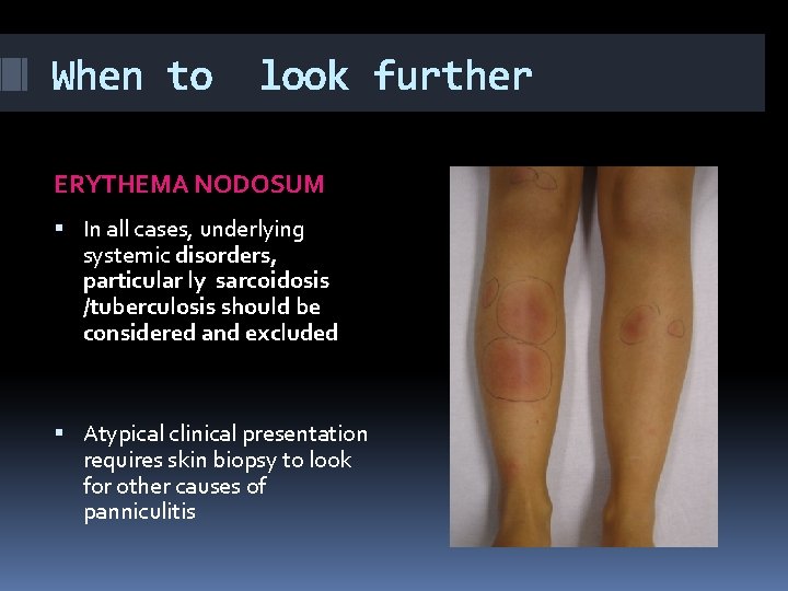 When to look further ERYTHEMA NODOSUM In all cases, underlying systemic disorders, particular ly