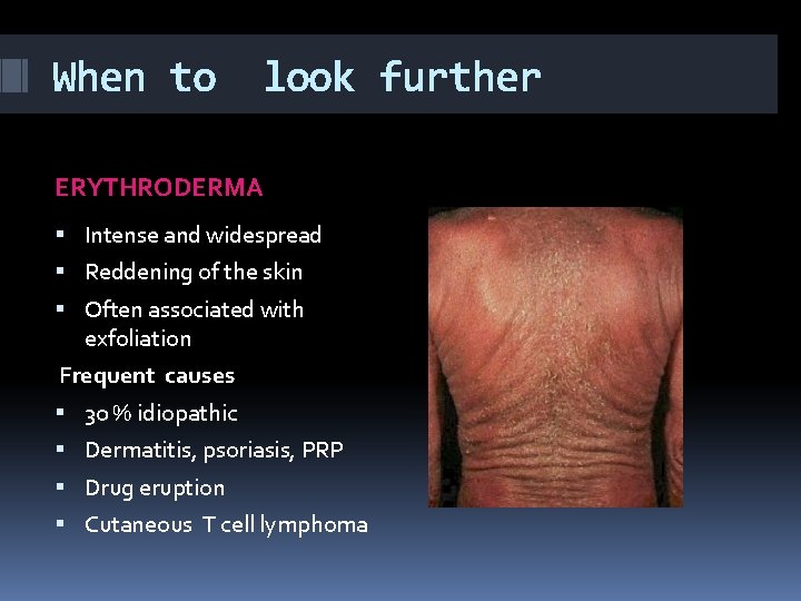 When to look further ERYTHRODERMA Intense and widespread Reddening of the skin Often associated