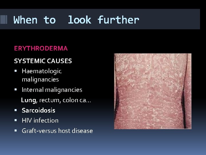 When to look further ERYTHRODERMA SYSTEMIC CAUSES Haematologic malignancies Internal malignancies Lung, rectum, colon