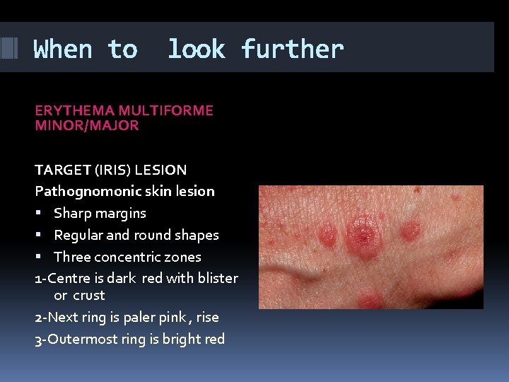 When to look further ERYTHEMA MULTIFORME MINOR/MAJOR TARGET (IRIS) LESION Pathognomonic skin lesion Sharp