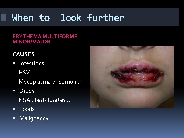 When to look further ERYTHEMA MULTIFORME MINOR/MAJOR CAUSES Infections HSV Mycoplasma pneumonia Drugs NSAI,