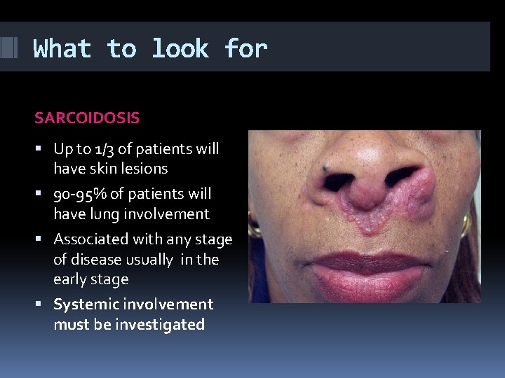 What to look for SARCOIDOSIS Up to 1/3 of patients will have skin lesions