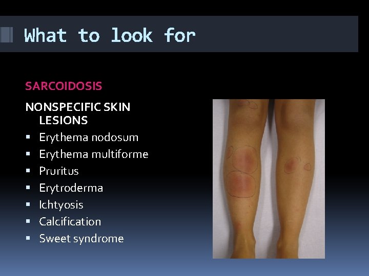 What to look for SARCOIDOSIS NONSPECIFIC SKIN LESIONS Erythema nodosum Erythema multiforme Pruritus Erytroderma