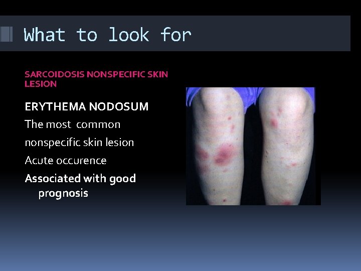What to look for SARCOIDOSIS NONSPECIFIC SKIN LESION ERYTHEMA NODOSUM The most common nonspecific