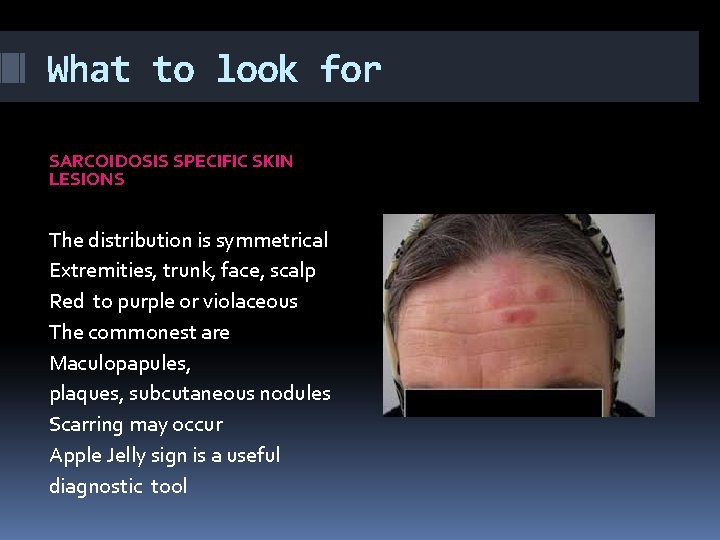 What to look for SARCOIDOSIS SPECIFIC SKIN LESIONS The distribution is symmetrical Extremities, trunk,