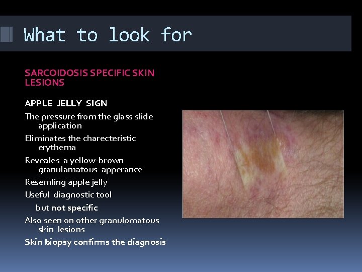 What to look for SARCOIDOSIS SPECIFIC SKIN LESIONS APPLE JELLY SIGN The pressure from