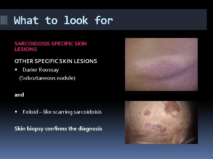 What to look for SARCOIDOSIS SPECIFIC SKIN LESIONS OTHER SPECIFIC SKIN LESIONS Darier Roussay