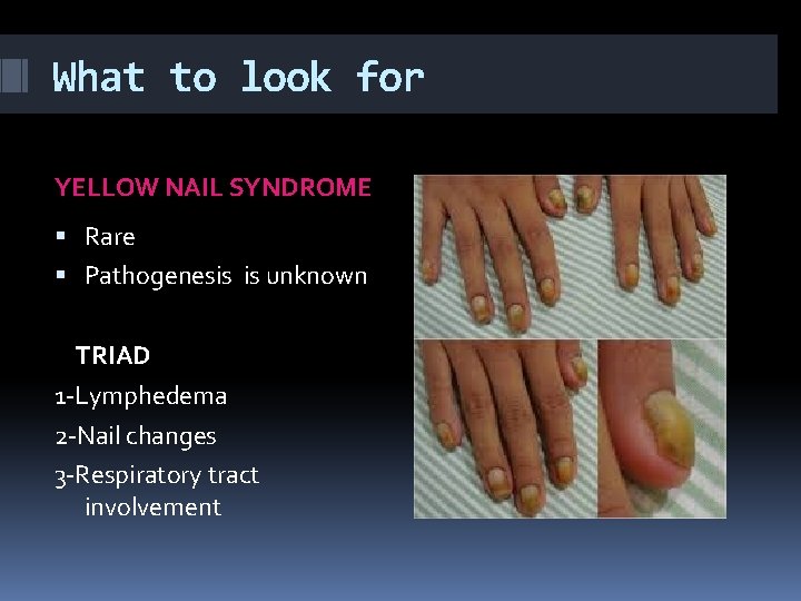 What to look for YELLOW NAIL SYNDROME Rare Pathogenesis is unknown TRIAD 1 -Lymphedema