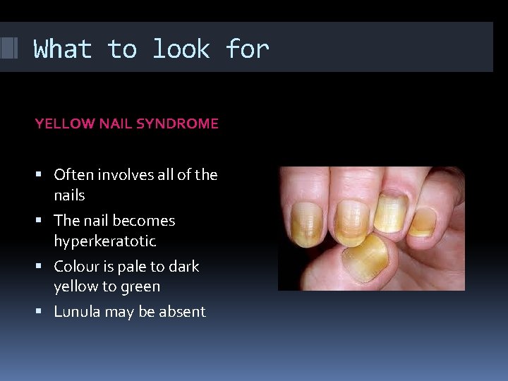 What to look for YELLOW NAIL SYNDROME Often involves all of the nails The