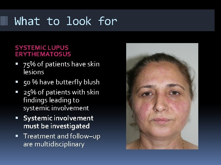 What to look for SYSTEMIC LUPUS ERYTHEMATOSUS 75% of patients have skin lesions 50