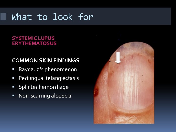 What to look for SYSTEMIC LUPUS ERYTHEMATOSUS COMMON SKIN FINDINGS Raynaud’s phenomenon Periungual telangiectasis