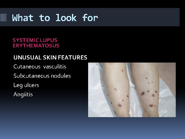 What to look for SYSTEMIC LUPUS ERYTHEMATOSUS UNUSUAL SKIN FEATURES Cutaneous vasculitis Subcutaneous nodules