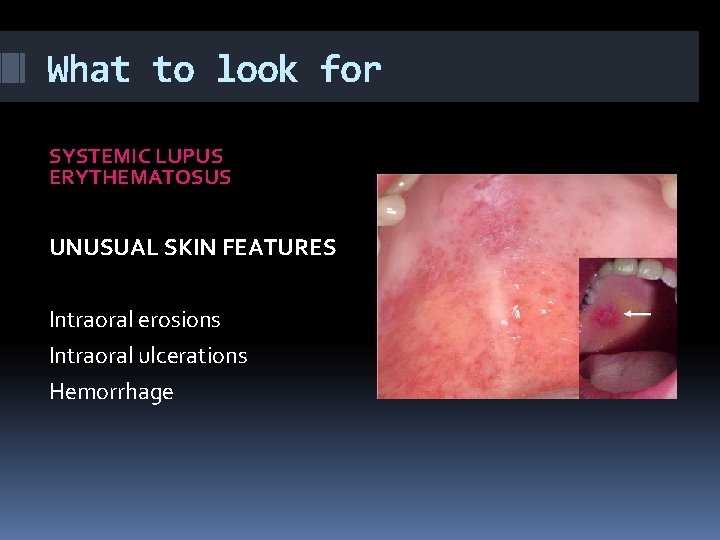 What to look for SYSTEMIC LUPUS ERYTHEMATOSUS UNUSUAL SKIN FEATURES Intraoral erosions Intraoral ulcerations