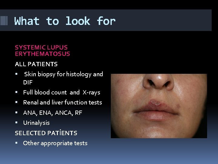 What to look for SYSTEMIC LUPUS ERYTHEMATOSUS ALL PATIENTS Skin biopsy for histology and