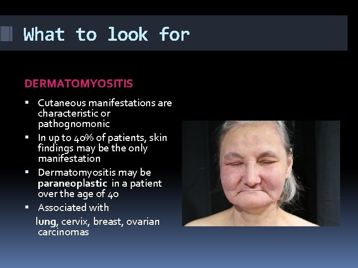 What to look for DERMATOMYOSITIS Cutaneous manifestations are characteristic or pathognomonic In up to