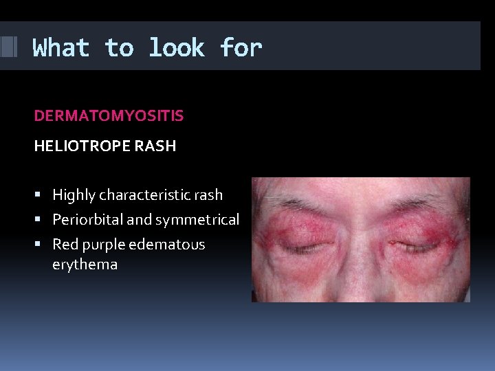 What to look for DERMATOMYOSITIS HELIOTROPE RASH Highly characteristic rash Periorbital and symmetrical Red