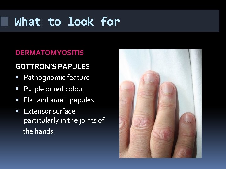 What to look for DERMATOMYOSITIS GOTTRON’S PAPULES Pathognomic feature Purple or red colour Flat