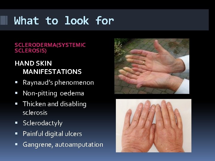 What to look for SCLERODERMA(SYSTEMIC SCLEROSIS) HAND SKIN MANIFESTATIONS Raynaud’s phenomenon Non-pitting oedema Thicken