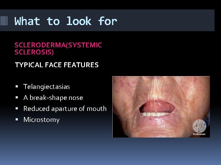 What to look for SCLERODERMA(SYSTEMIC SCLEROSIS) TYPICAL FACE FEATURES Telangiectasias A break-shape nose Reduced