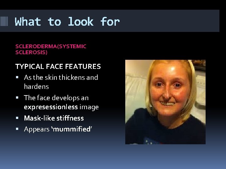 What to look for SCLERODERMA(SYSTEMIC SCLEROSIS) TYPICAL FACE FEATURES As the skin thickens and