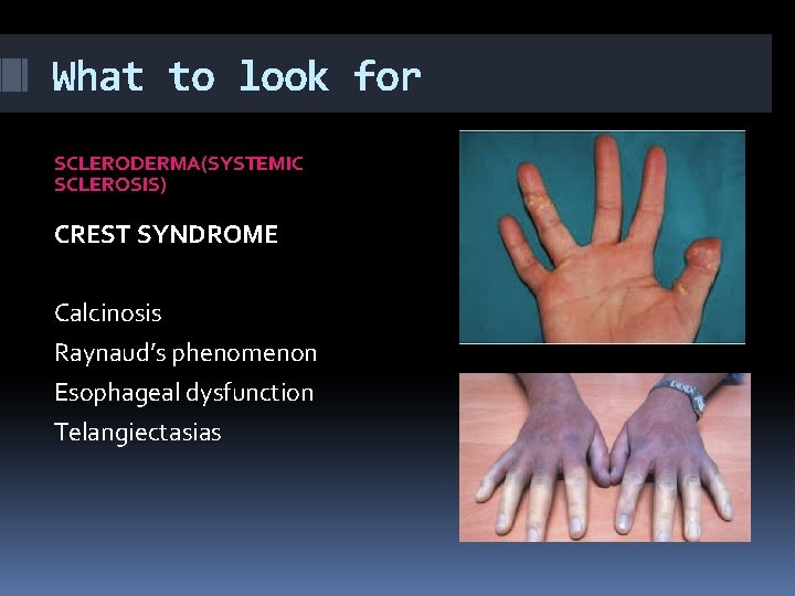 What to look for SCLERODERMA(SYSTEMIC SCLEROSIS) CREST SYNDROME Calcinosis Raynaud’s phenomenon Esophageal dysfunction Telangiectasias