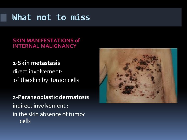 What not to miss SKIN MANIFESTATIONS of INTERNAL MALIGNANCY 1 -Skin metastasis direct involvement: