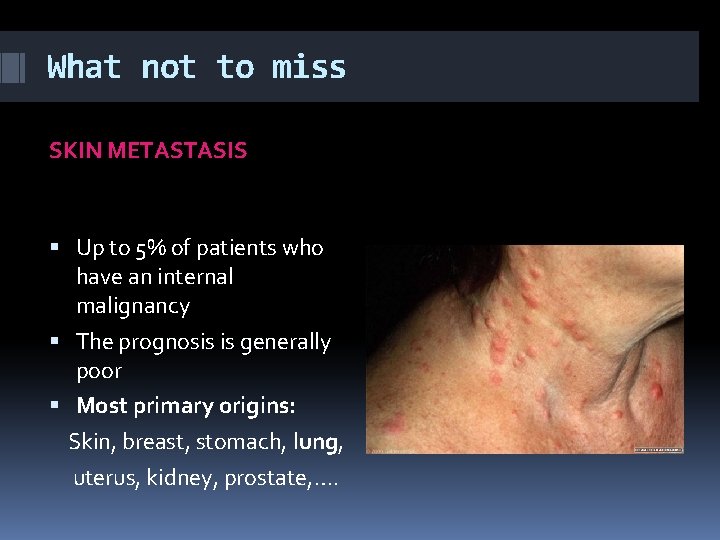 What not to miss SKIN METASTASIS Up to 5% of patients who have an