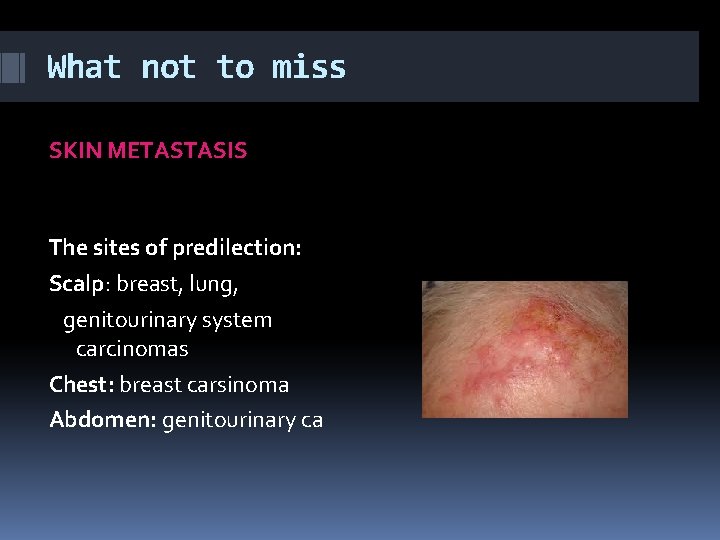 What not to miss SKIN METASTASIS The sites of predilection: Scalp: breast, lung, genitourinary