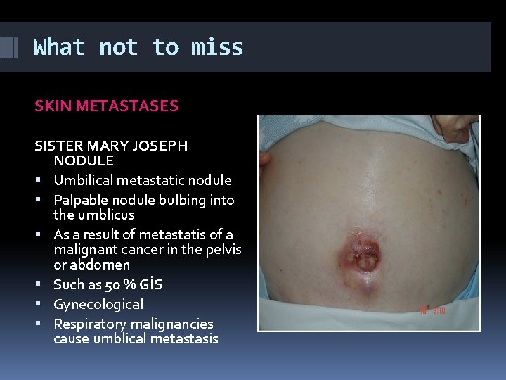 What not to miss SKIN METASTASES SISTER MARY JOSEPH NODULE Umbilical metastatic nodule Palpable